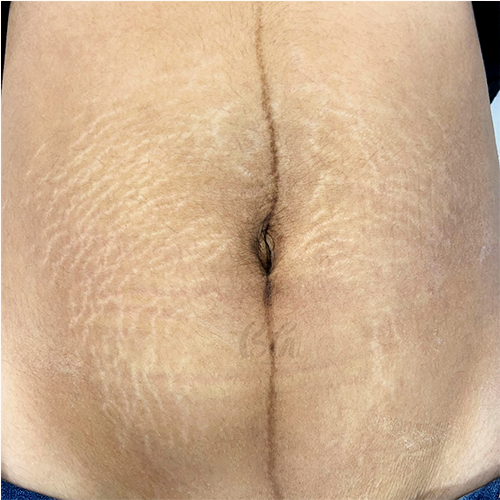 Antes do tratamento de estrias