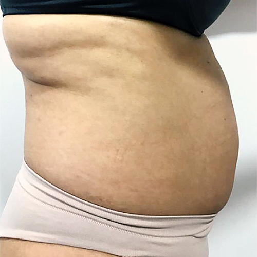 Antes da massagem modeladora