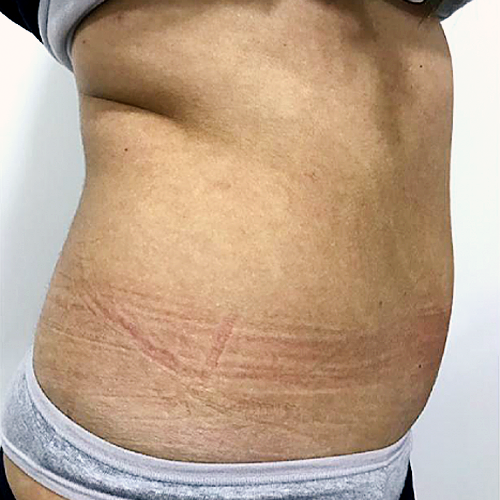 Depois da massagem modeladora